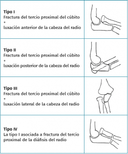 Fracturas Del Extremo Proximal De Cúbito Y Radio | FONDOSCIENCE